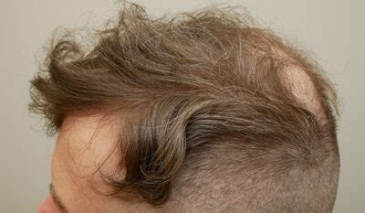 hair replacement st louis|Man Weave St Louis .